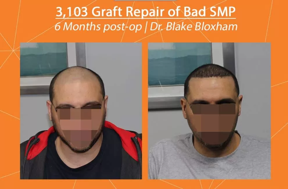 What is Scalp Micropigmentation (SMP) for Hair Loss? - Feller & Bloxham Medical