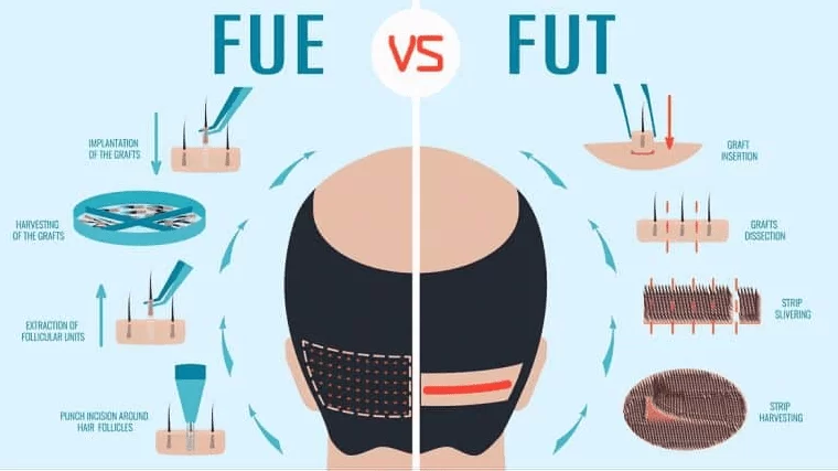 FUT Transplant vs. FUE Transplant