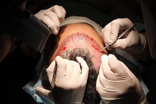 History of Hair Transplants Surgery
