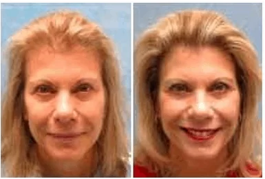 Hair Restoration for Women New York