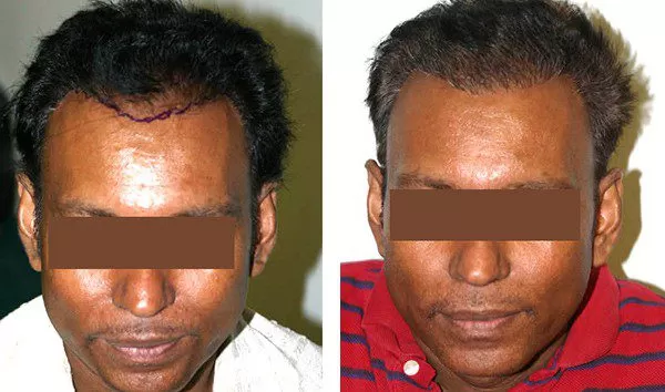 Patient 79 Hair Photos- FELLER & BLOXHAM MEDICAL