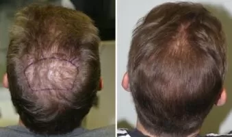 Patient 8 Hair Photos- FELLER & BLOXHAM MEDICAL