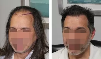 Patient 22 Hair Photos- FELLER & BLOXHAM MEDICAL