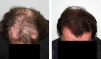 Patient 32 Hair Photos- FELLER & BLOXHAM MEDICAL